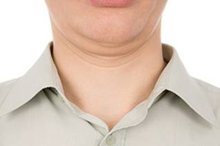 Kybella double chin